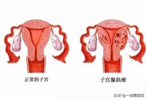 子宫肌瘤什么原因会越长越大,子宫肌瘤医生为什么建议切除子宫