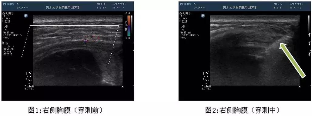 ct引导下穿刺活检诊断的分析,超声引导下穿刺活检什么样子的呢