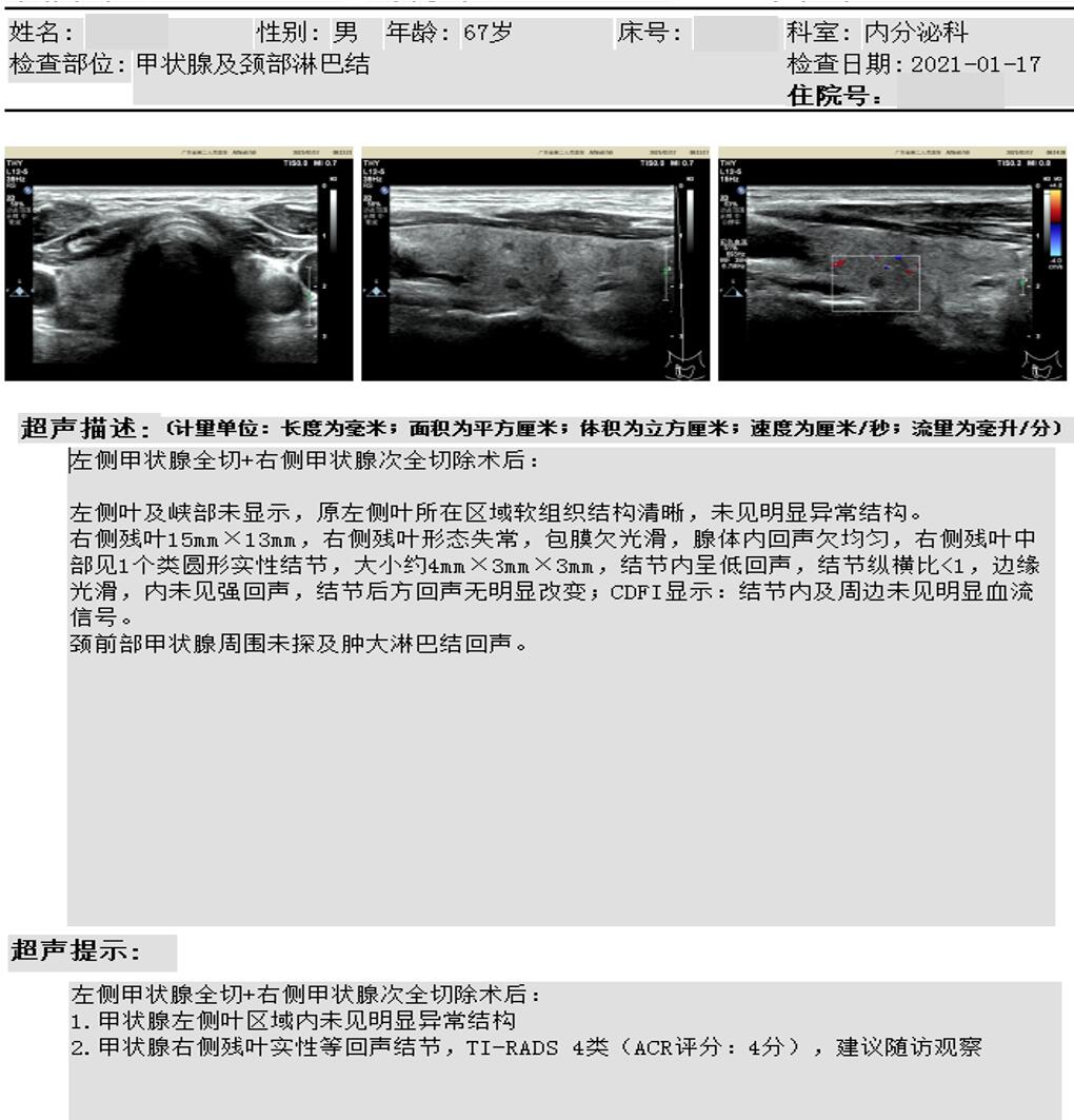 甲状腺右残叶再发3.5毫米（芝麻粒大小）结节，何去何从？