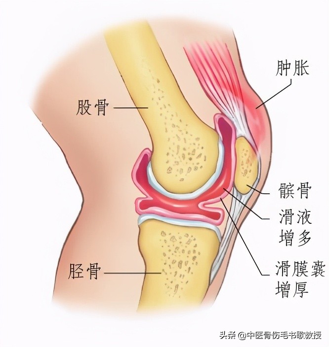滑膜炎膝盖肿胀蹲不下怎么治,膝盖滑膜炎肿胀疼有什么偏方治疗