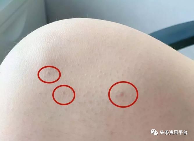 千谷德国溶脂线减肥功效是什么,千谷生物科技