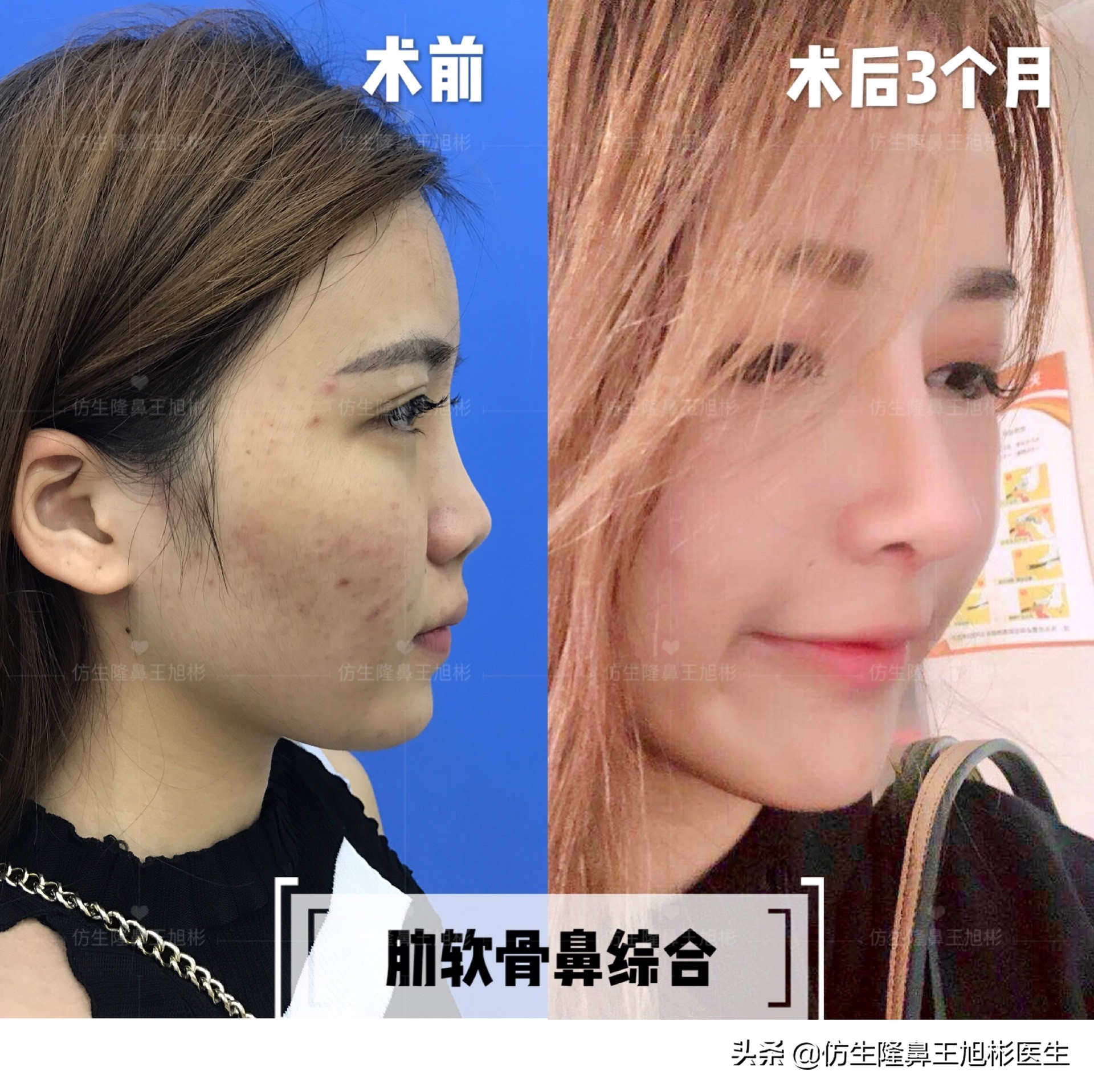 最安全的隆鼻方法,隆鼻的方法有几种及各自的优缺点