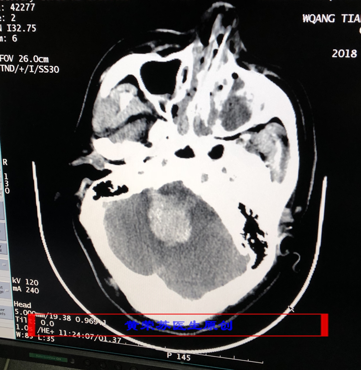 脑出血症状科普动画视频,脑出血的出血部位脑细胞会坏死吗