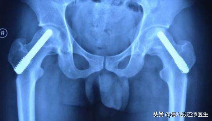 老年人股骨颈骨折会股骨头坏死吗,老年人股骨头摔断能治愈吗