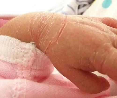宝宝手脚干裂起皮怎么办,手脚干裂脱皮还有点疼怎么回事