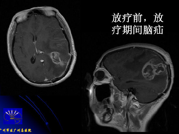 中医认为胶质瘤怎么来的,医学上什么叫胶质瘤