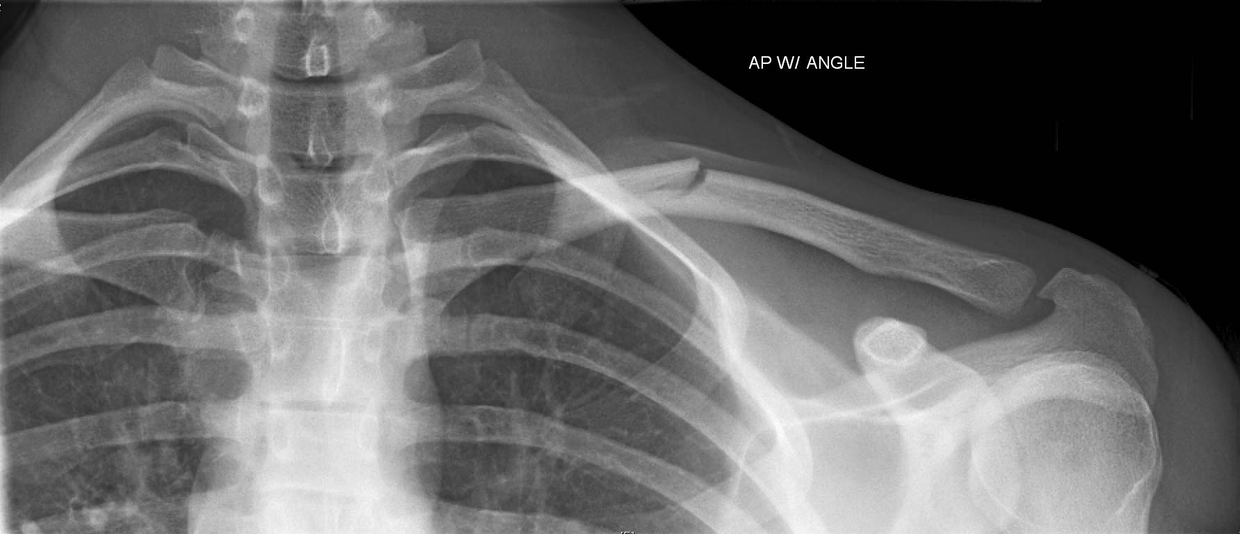 锁骨骨折尽量不要做手术,锁骨骨折手术加钢板视频