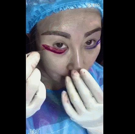 微整形需要多久,微整形后多久恢复正常