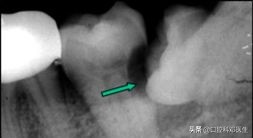 上颌左边埋伏阻生牙的拔除视频,埋伏阻生牙拔除会得干槽症吗