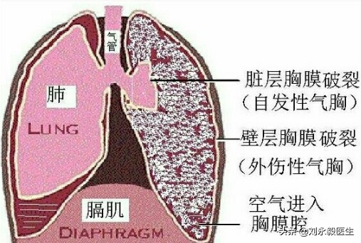 气胸是怎么治疗最好的,气胸是怎么回事