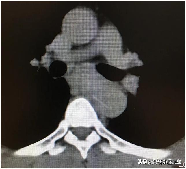 误吞假牙吃什么有助于排出,误吞假牙怎么处理