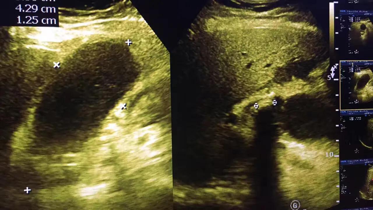 一公分胆结石并且引发急性胆囊炎,一颗胆结石必须摘胆吗