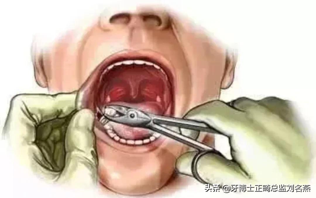 智齿拔除肿成猪头多久恢复,拔了智齿为什么脸肿了
