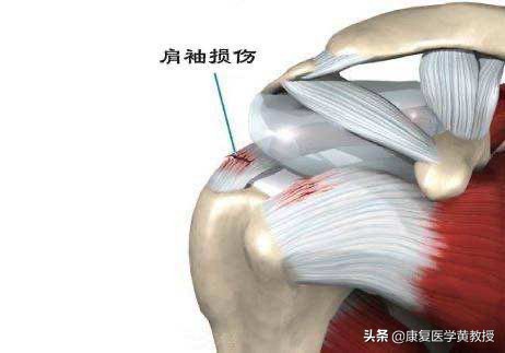 黄教授讲脑梗,中风后遗症肩痛的康复治疗