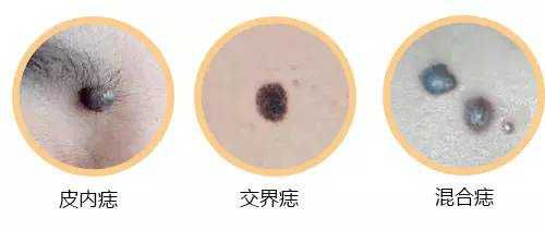 中医点痣最好方法,中医古方中草药点痣