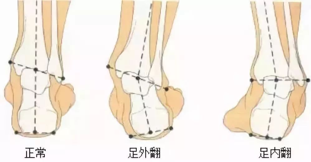 足部健康知识,足外翻的治疗及护理