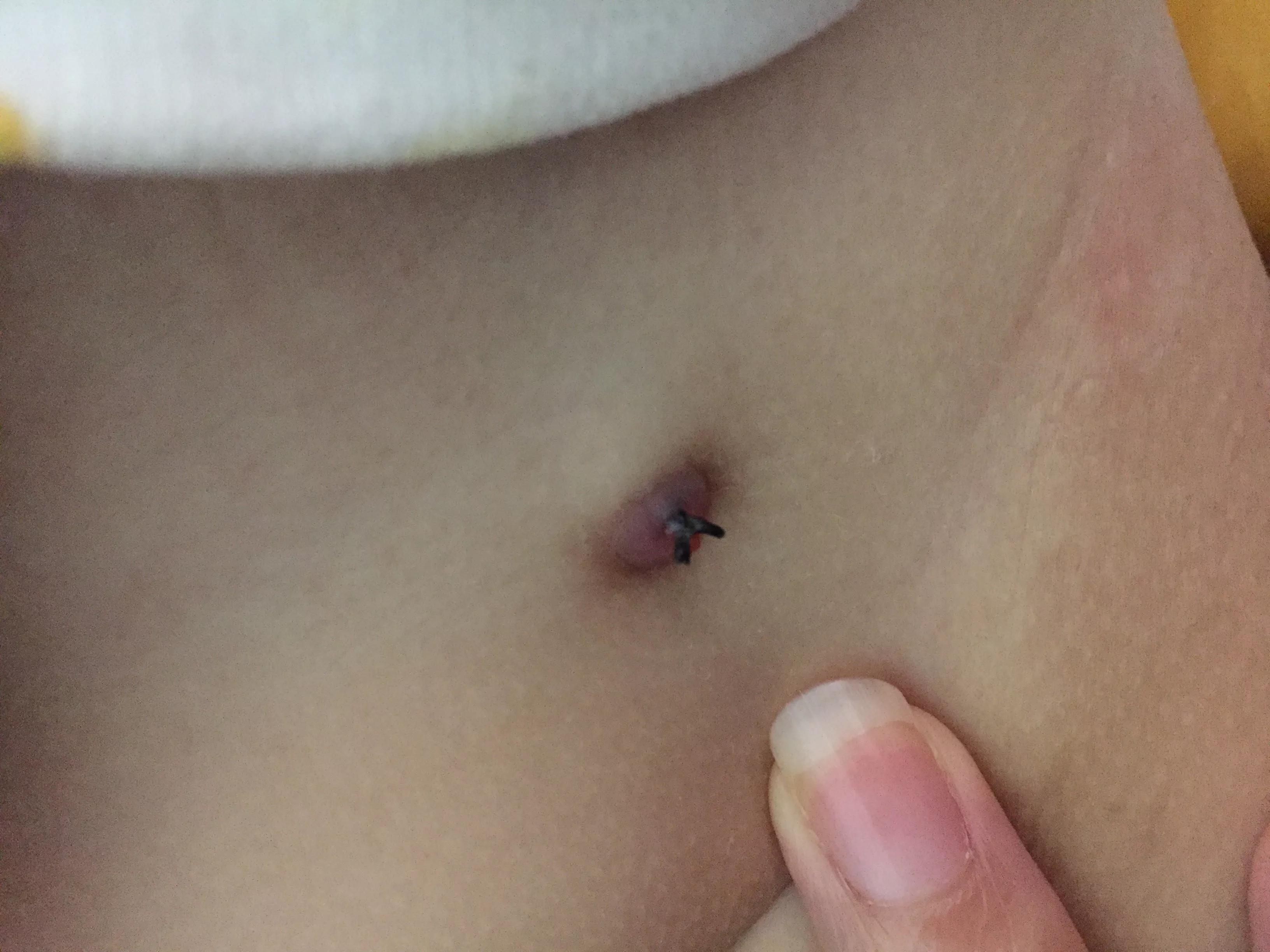 手术后四个月了伤口还是很红,手术后一个月还有线头正常吗