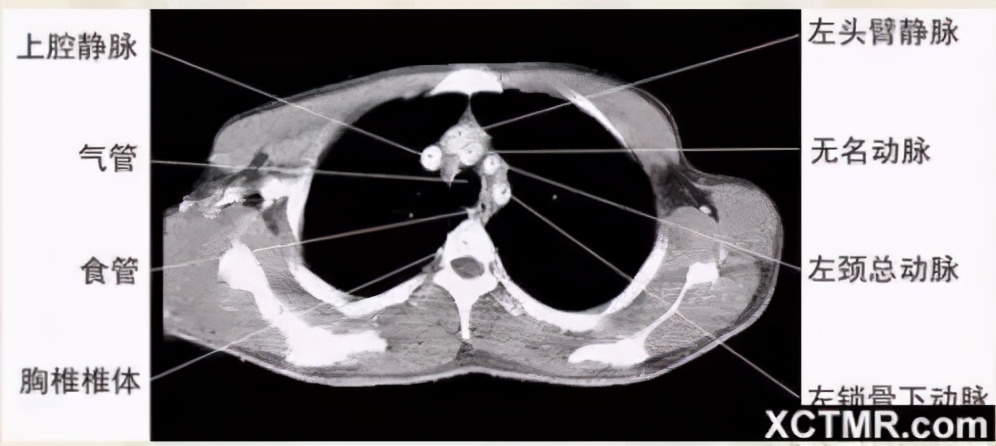 女性盆腔ct断层解剖结构图,女性盆腔脏器ct解剖