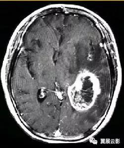 脑部脓肿怎么治疗,多发性脑脓肿能自愈吗