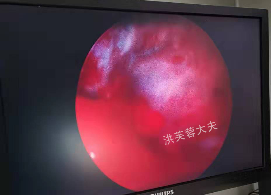 宫腔造影输卵管微创手术,宫腔粘连盆腔积液做宫腹腔镜手术