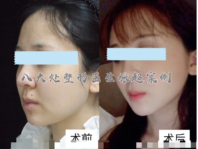 八大处整形张超,八大处张超最新视频