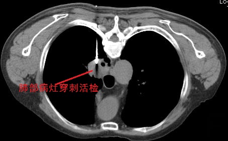 肺癌！已经发了CT诊断报告，还有必要做穿刺？不算重复吗？