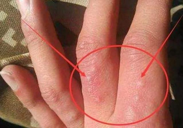 为了避免手上起水泡该怎么预防,一到天热手上起水泡脱皮