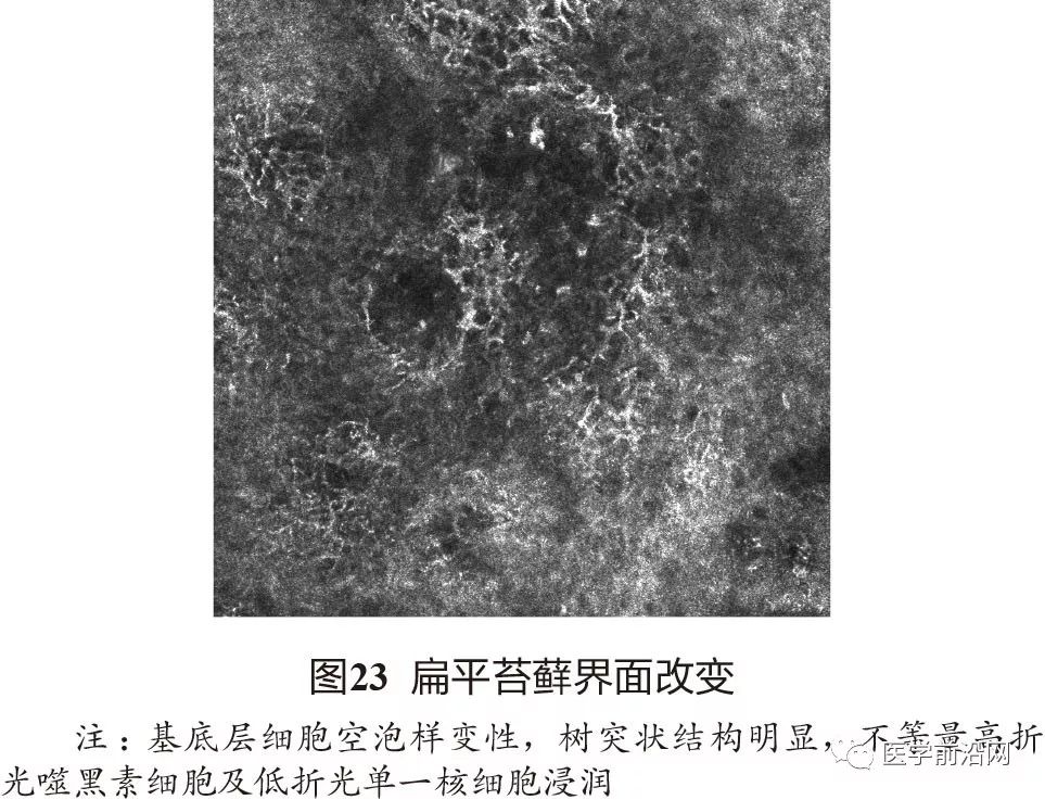 炎症性皮肤病反射式共聚焦显微镜诊断特征专家共识全文发布