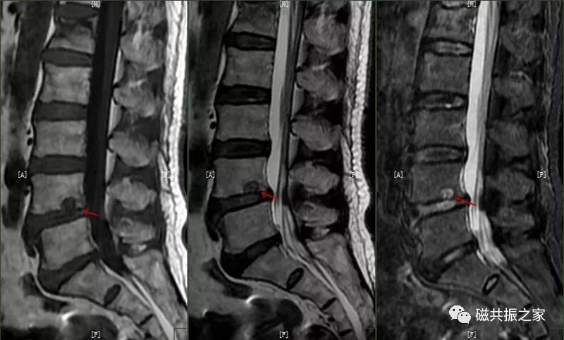 腰椎有哪些病变,腰椎病变有几种