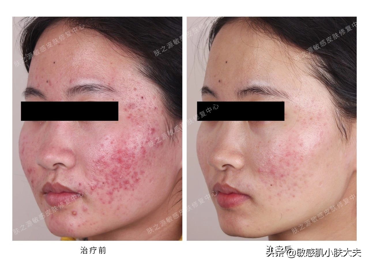 阿达帕林怎么用才正确,阿达帕林怎么用不烂脸