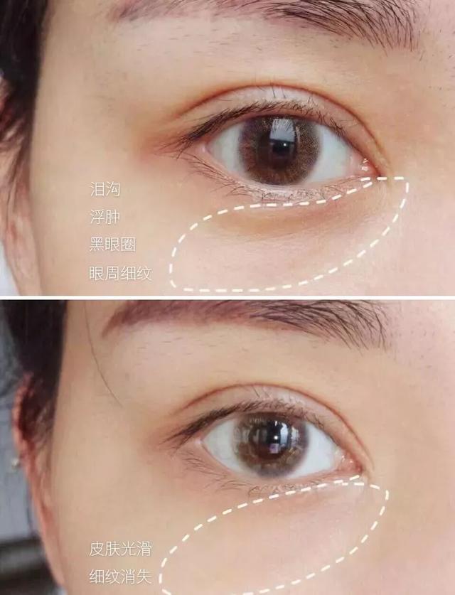 脂肪粒应该怎样用针挑,脂肪粒用针挑越挑越多