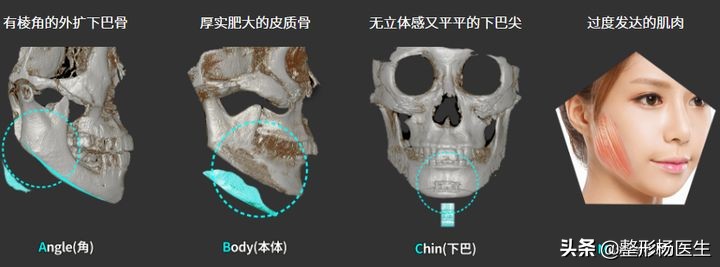 女生国字脸削骨头整容,国字脸女整形