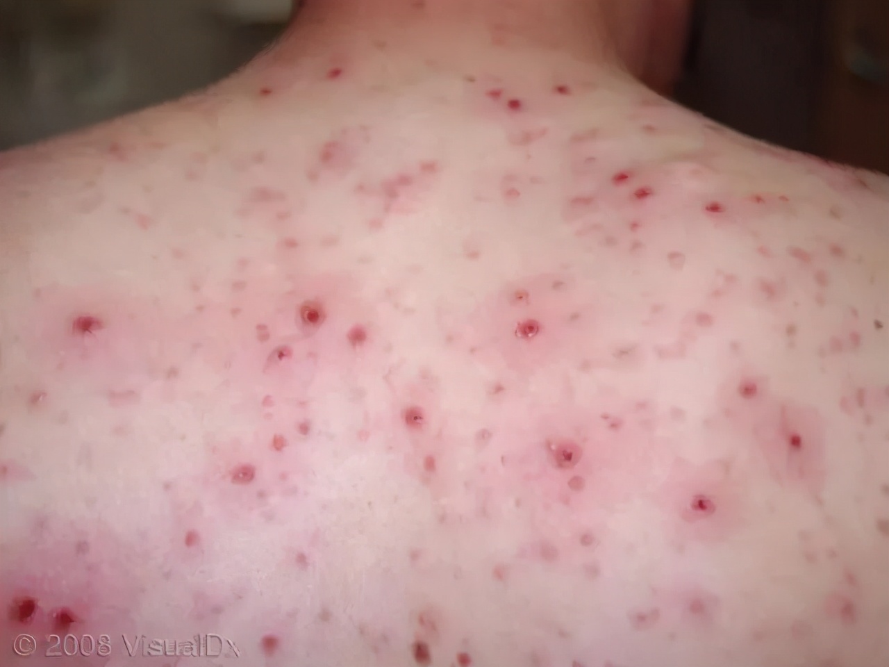 水痘高发期宝妈必知战痘攻略,水痘高发季这波操作助你轻松战痘