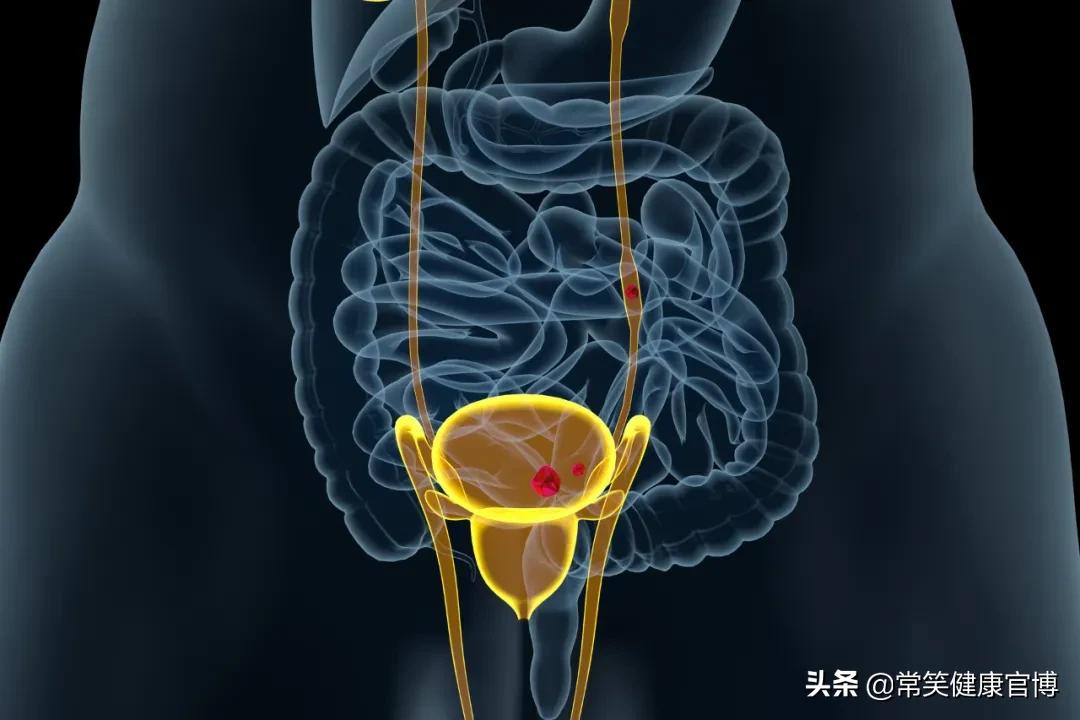 尿路感染最常见的原因是,发生医院内尿路感染最常见的原因