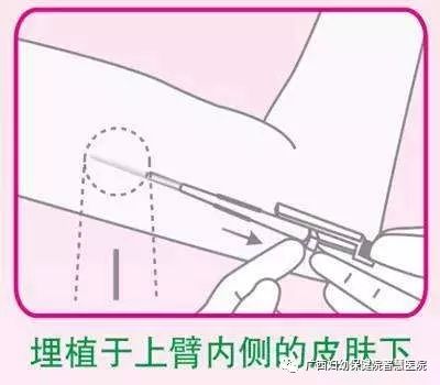 健康学堂｜这么避孕，安全率可以达到99.5%！