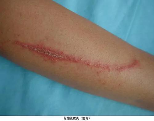 小孩被毒虫咬伤后去医院说很危险,宝宝被隐翅虫咬伤图片