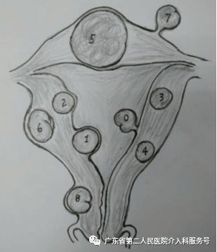 子宫肌瘤引起大姨妈一直来怎么办,子宫肌瘤大姨妈多怎么办