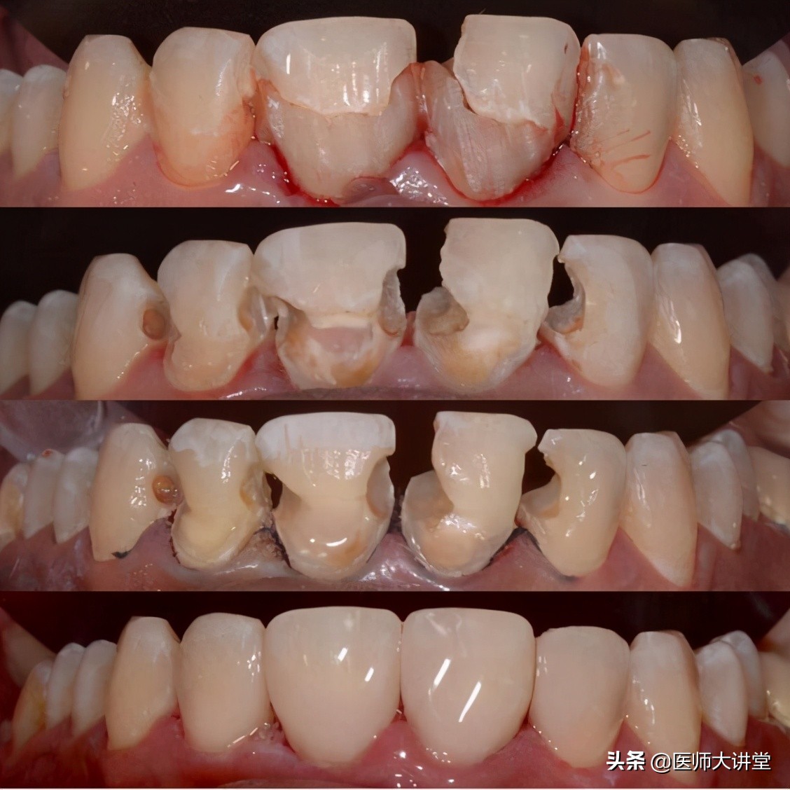 金属假牙托牙制作全过程,自己在家做树脂假牙新技术