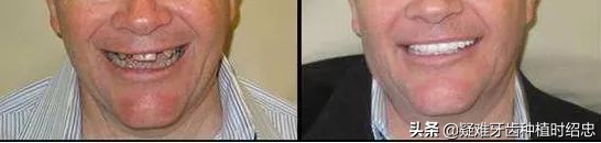 只剩残根的牙真的能补救吗,烂的只剩下黑色残根的牙怎么处理