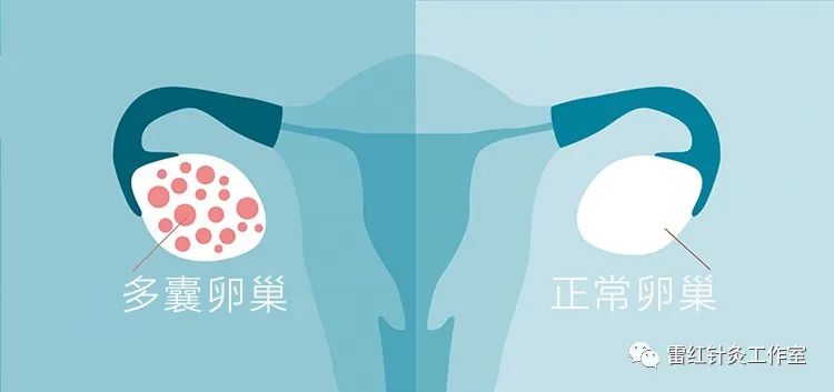 多囊卵巢综合征患者能自然怀孕吗？