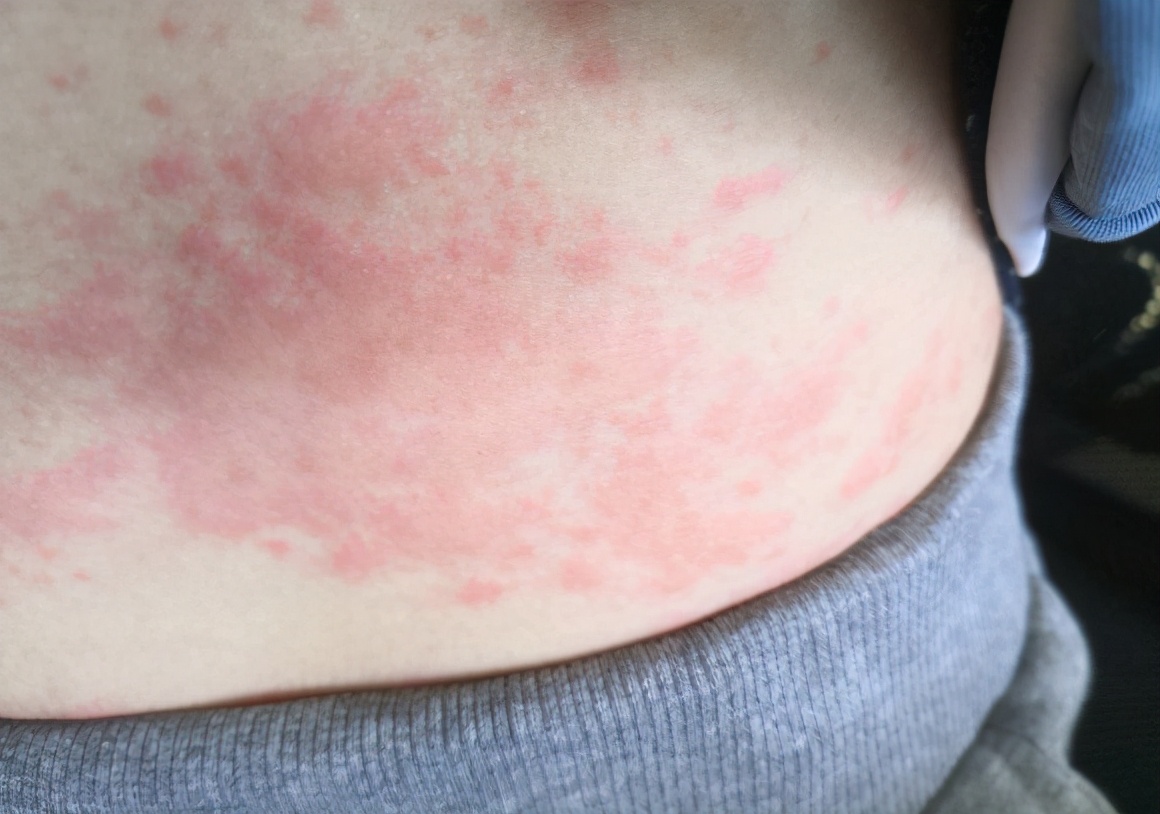 宝妈皮肤过敏怎么办,过敏性皮炎皮肤痒怎么办