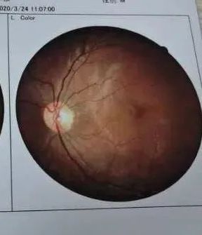 紧急救援之眼球脱落,紧急救援小男孩眼睛失明