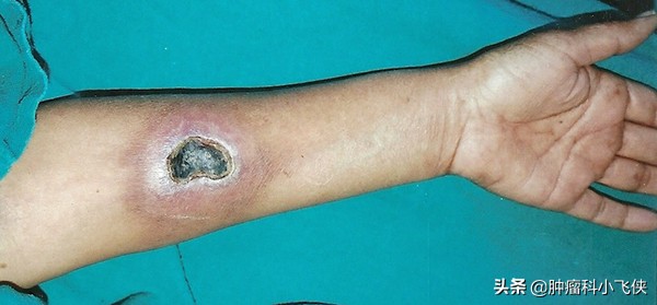 化疗埋管保证治疗顺利进行,一旦药物外渗患者遭罪又耽误治疗