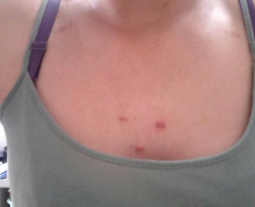 胸前长痘痘和有痘印怎么消除,为什么胸前长痘痘还有色斑