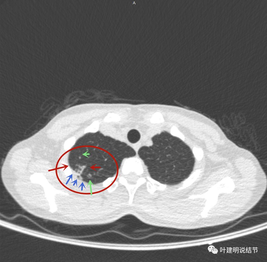 临床诊断孤立性肺结节,空洞型结节一般是什么性质