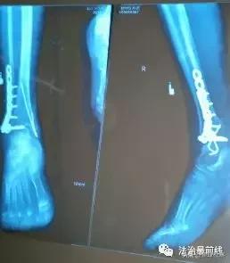 女子骨折术后,骨折术后复查发现钢钉有错位