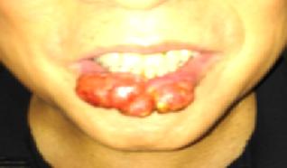 为了唇活苦寻放疗