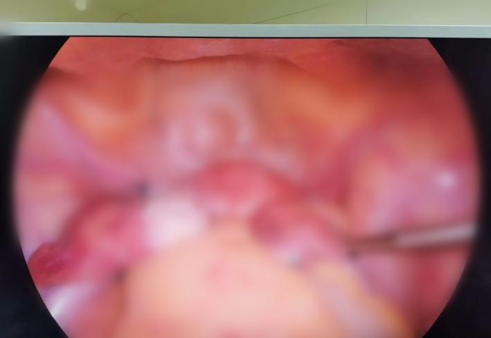 女性妇科微创手术,太原市妇科手术最好的医院