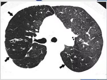 肺部ct十大征象,肺部ct正常图和异常图的区别