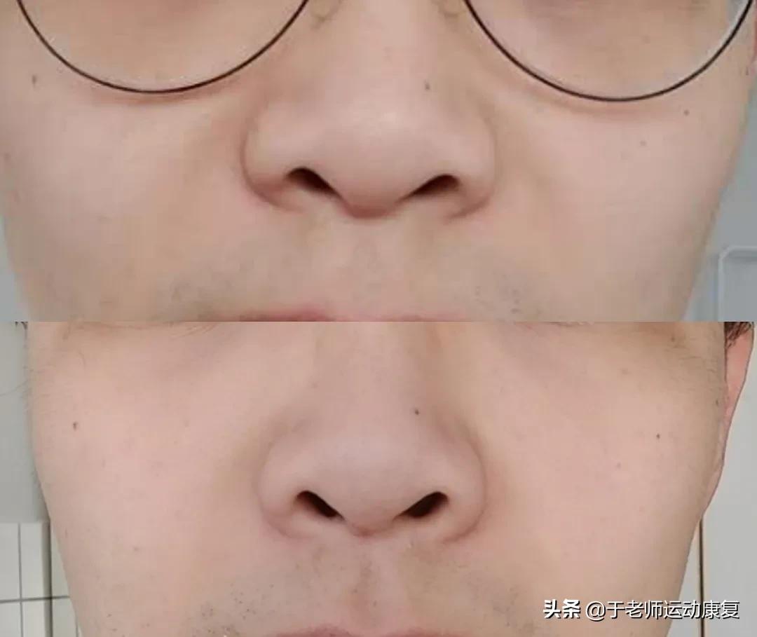 抗皱纹的有效方法,二十多岁脸上就有法令纹了怎么办